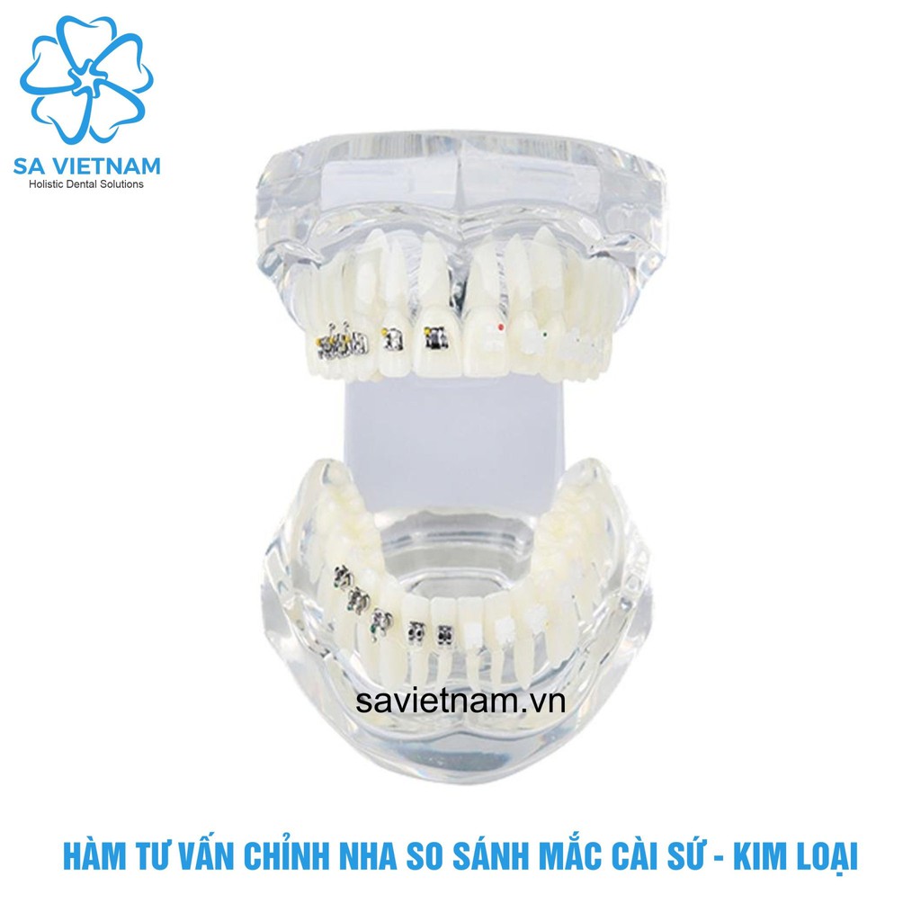 Mẫu hàm tư vấn so sánh chỉnh nha mắc cài kim loại và mắc cài sứ – mô hình nắn chỉnh răng nha khoa