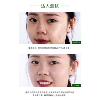 MẠT NẠ BÌ HEO SỦI BỌT THẢI ĐỘC BIOAQUA