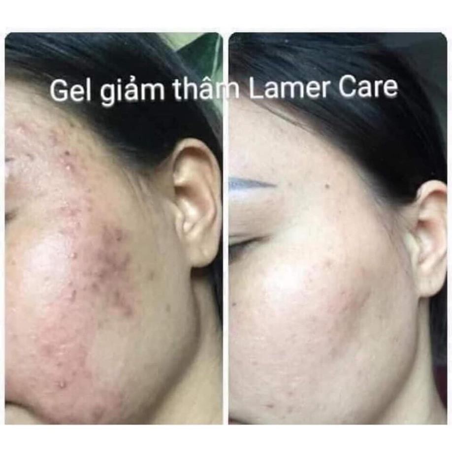 [tặng nạ thủy tinh] Gel Thâm Lamer drlacir ,Gel giảm Thâm,giảm và ngừa tăng sắc tố,giảm thâm do mụn (bán chạy)