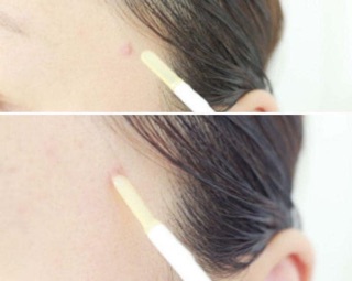 [Bill Hàn] Thanh CHẤM MỤN APIEU Nonco Tea Tree STICK