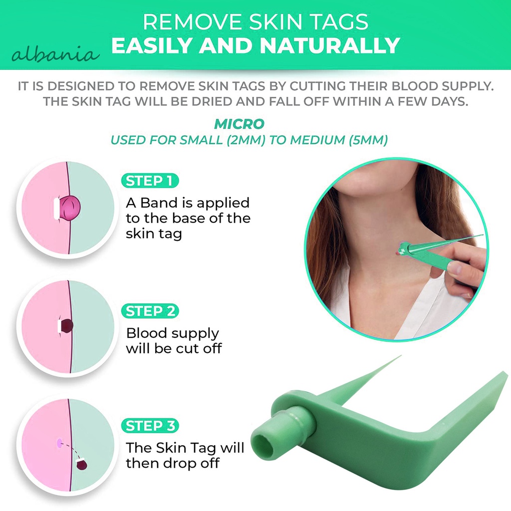 &lt; Albania &gt; Bộ Tăm Bông Tẩy Mụn Cóc Da Không Đau Dễ Sử Dụng Cho Toàn Thân