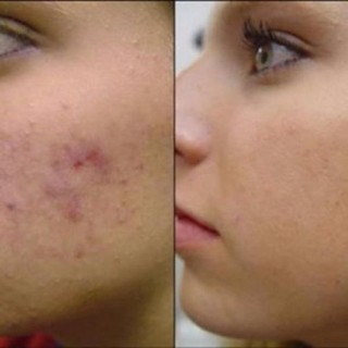 KEM ĐẨY MỤN ẨN RETIN - A (TRETINOIN)