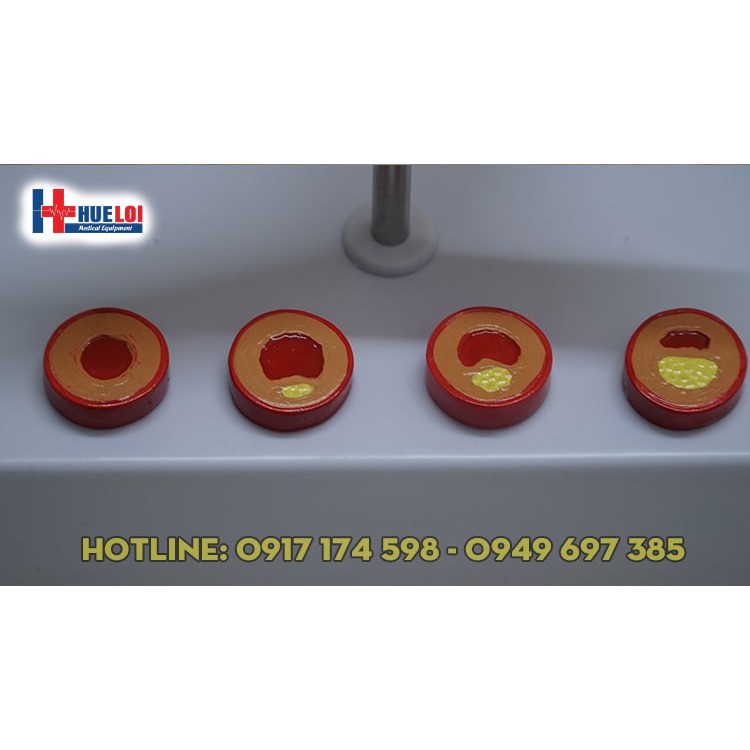 Mô hình huyết khối kèm  xơ vữa động mạch vành