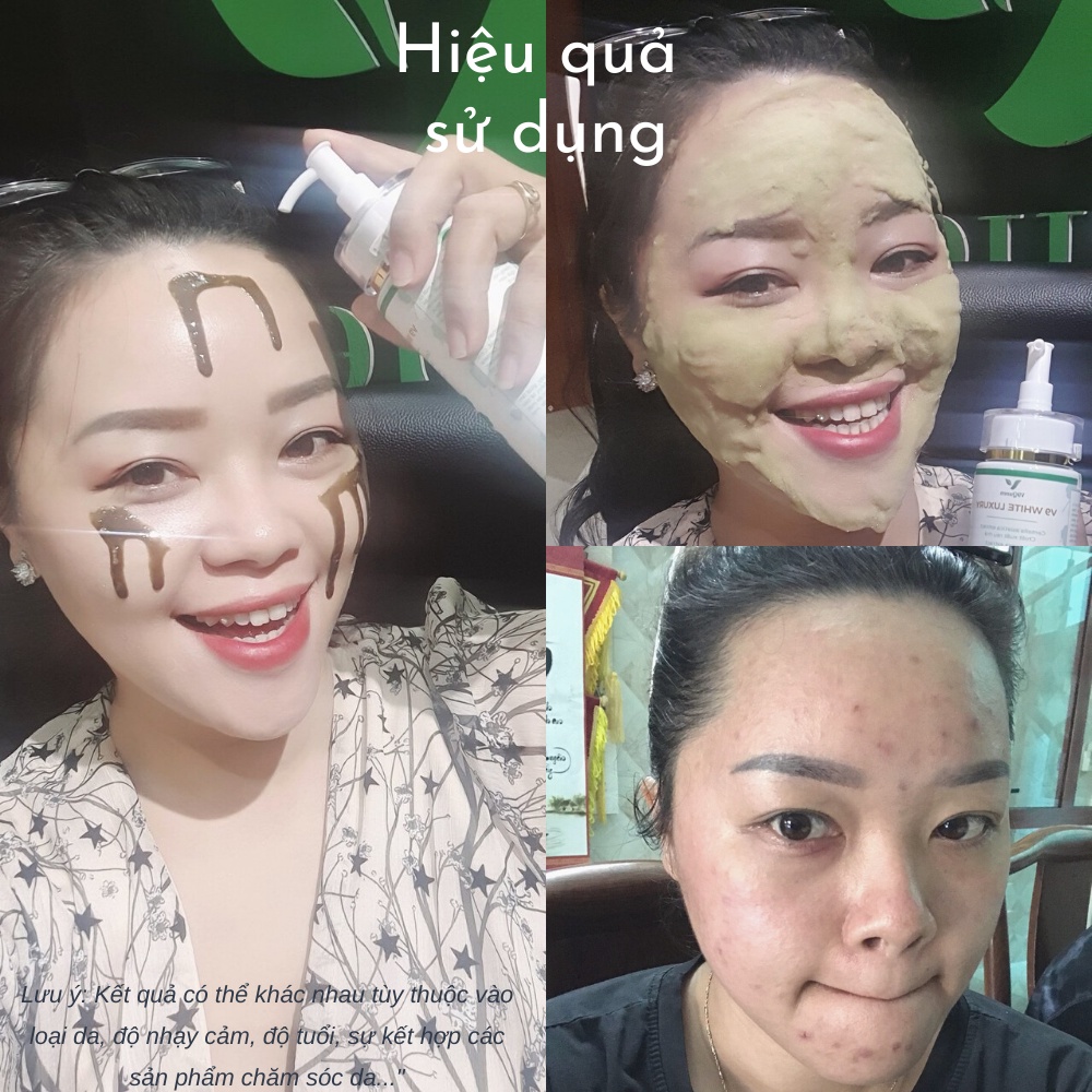 Sữa rửa mặt tạo bọt rau má V9Queen, giúp giảm mụn mờ thâm nám tàn nhang dưỡng trắng da