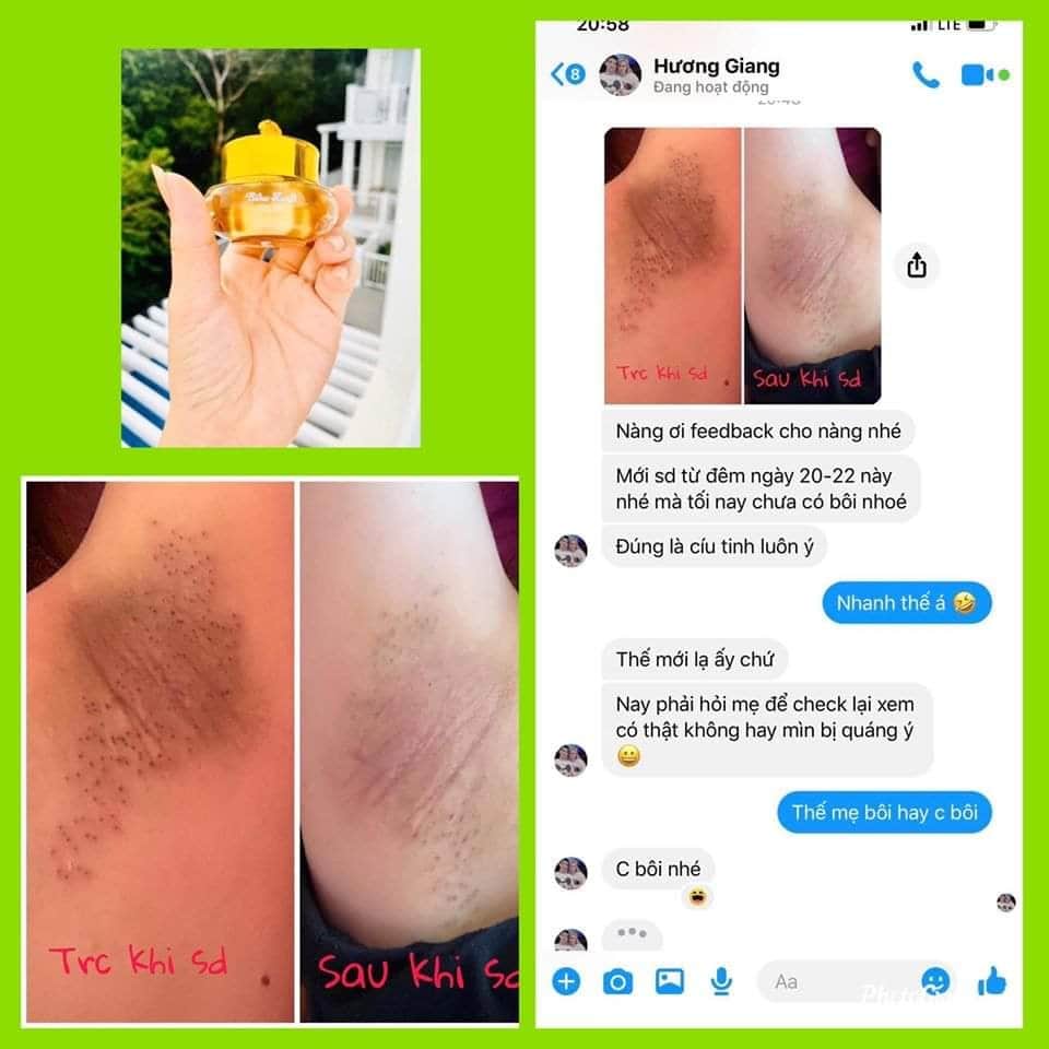 Siêu Dưỡng Thâm BIHOLADI [ cam kết chính hãng] | BigBuy360 - bigbuy360.vn