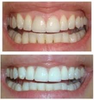 MIẾNG DÁN RĂNG ORAL B 3D WHITE WHITESTRIPS