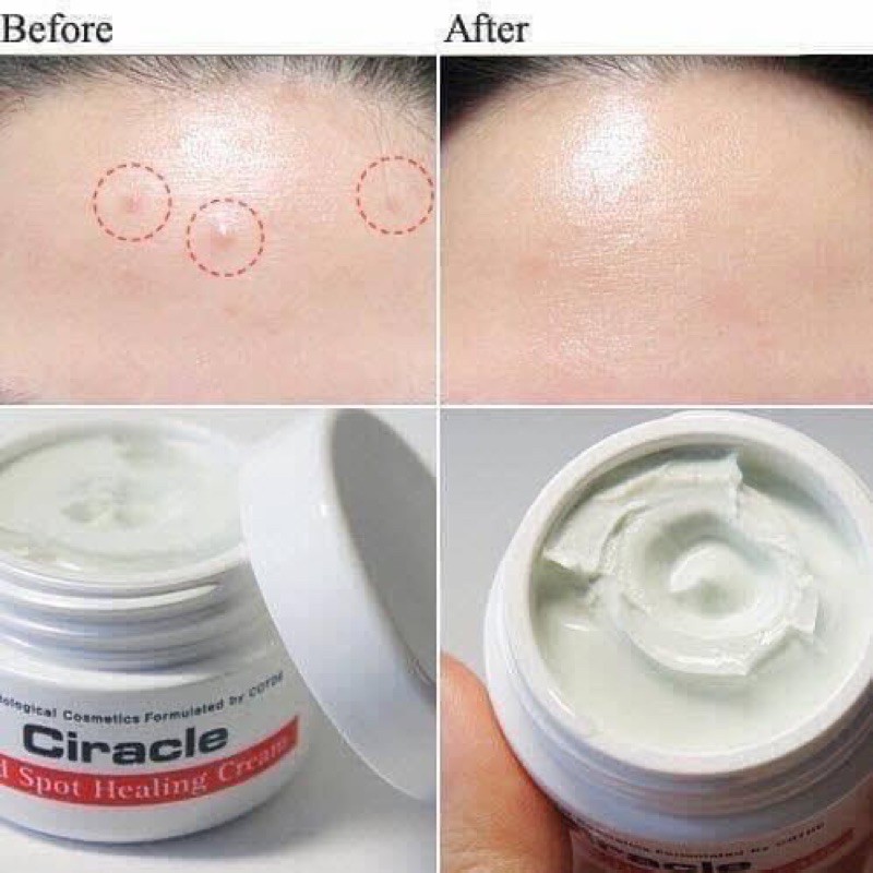 KEM NGĂN NGỪA MỤN VIÊM VÀ SẸO CIRACLE RED SOPT CREAM CHÍNH HÃNG