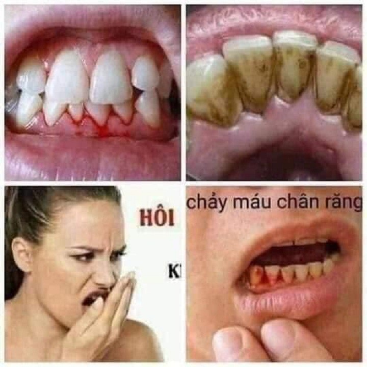 [CHÍNH HÃNG] THAN HOẠT TÍNH TRẮNG RĂNG GỐC VIỆT VƯỢT TRỘI GẤP 10 LẦN