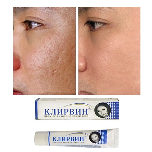 Kem mờ sẹo lồi lõm, thâm sẹo Klirvin 25ML giúp mờ sẹo trong 2 tháng hàng Nga chính phẩm