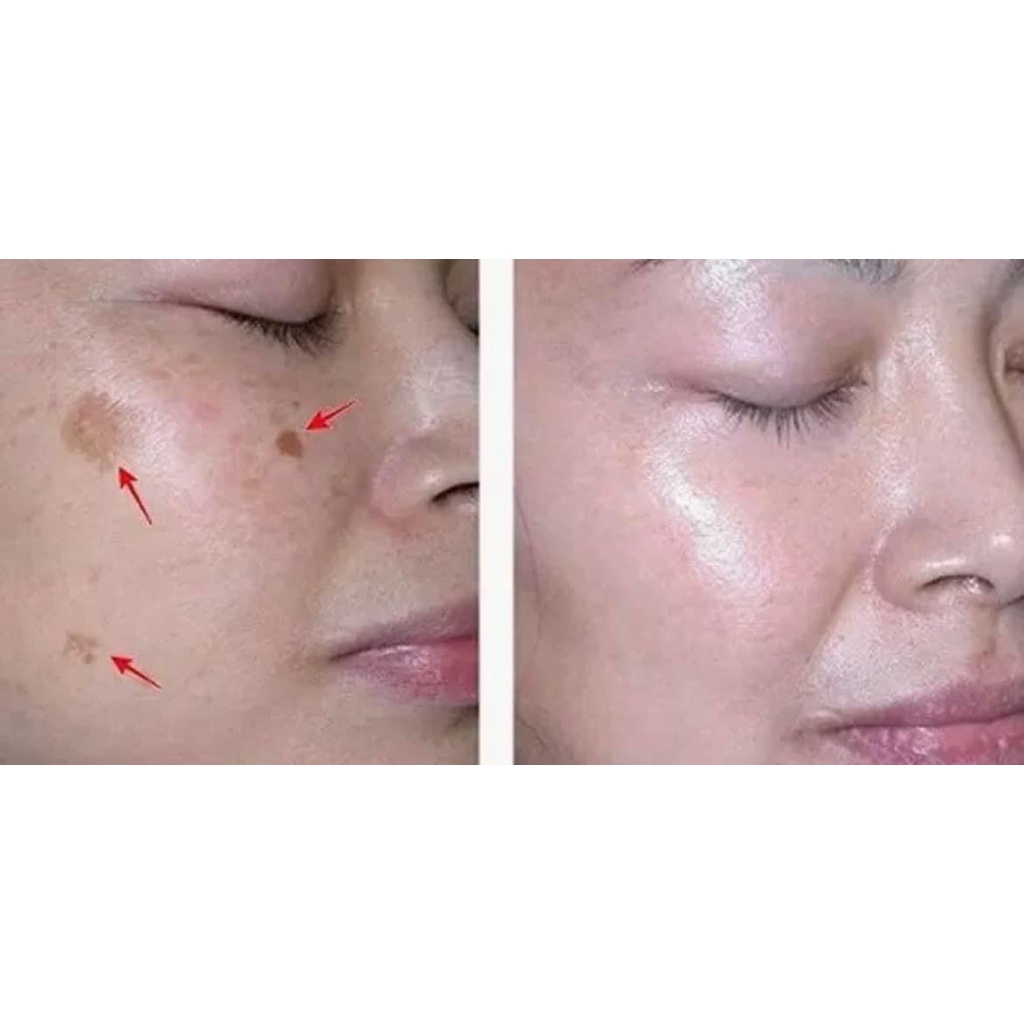 ( CHÍNH HÃNG ) KEM NÁM TRỨNG CÁ MUỐI VÀNG PEEL ONE - Tặng tẩy kỳ collagen - Hộp 18gr