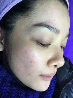 Tone trị mụn của Nhật - hip1994@