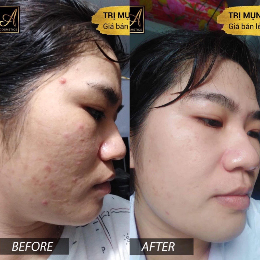 Bộ 2 sản phẩm loại mụn, làm sạch da Acosmetics: Kem loại bỏ mụn siêu tốc và Sữa rửa mặt trà xanh 120ml