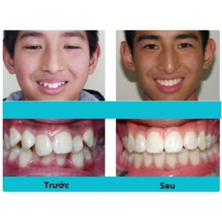 (A1+A2) Dụng cụ niềng răng cho trẻ em