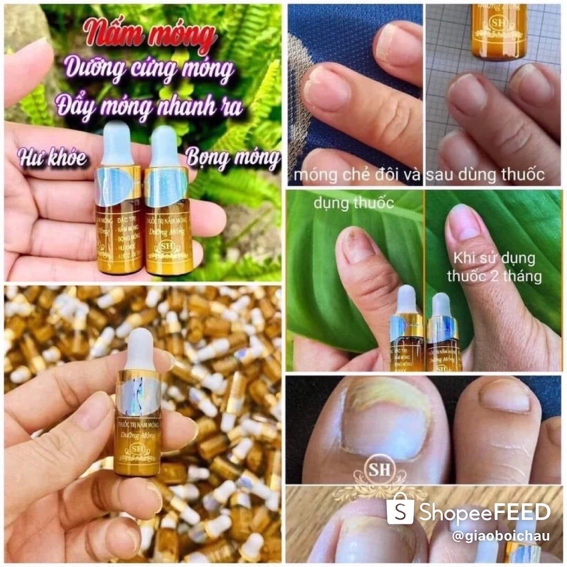 Liệu trình phục hồi nấm móng, hư khoé, bọng móng nước ăn chân.