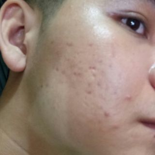 PEEL THAY DA MẶT TCA DÀNH CHO NAM