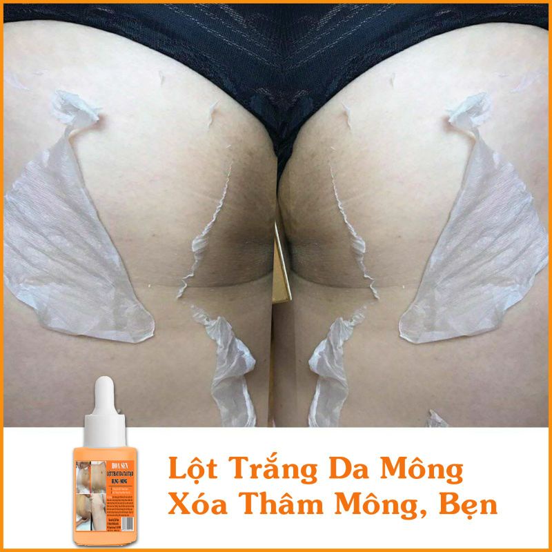 Lột Thay Da Tái Tạo Bụng Mông Bẹn Mờ Rạn Nứt Hết Thâm Sạm