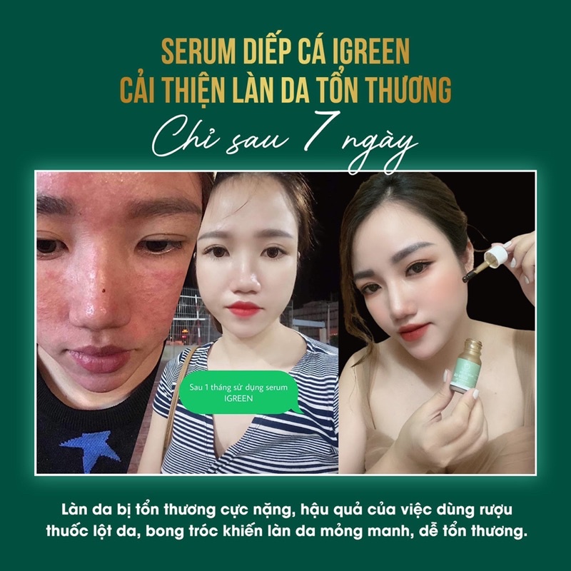 Serum IGREEN Diếp cá Sạch mụn, mờ thâm, thu nhỏ lỗ chân lông 10ml | BigBuy360 - bigbuy360.vn