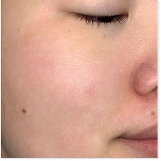 Sữa Rửa Mặt Dạng Gel Eucerin Acne-Oil Control Pro Acne Solution Cleansing Gel