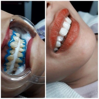 Banh miệng làm răng trong spa thẩm mỹ