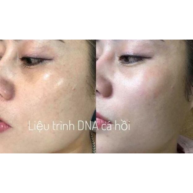 (1 Ống) [Chuẩn Hàn]Tế Bào Gốc Cá Hồi SUPER SKIN SALMON DNA Chính Hãng