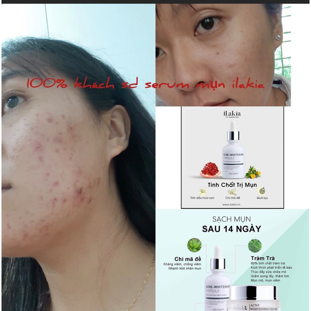 Tinh Chât Serum Ngừa Mụn Dưỡng Da Trà Tràm ILAKIA Dưỡng Da, Mờ Thâm, Se Khít Lỗ Chân Lông Chính Hãng Hàn Quốc | BigBuy360 - bigbuy360.vn
