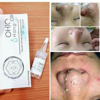 Serum Ủ Mụn Cám Đầu Đen Mụn Bọc Siêu Hot