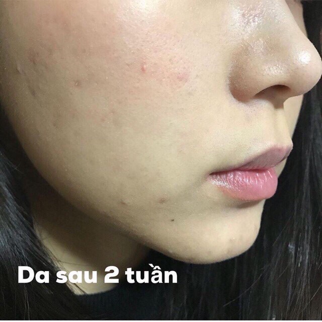 Nước Hoa Hồng Toner Bigansui Meishoku Mụn - Lotion mụn Meishoku bigansui