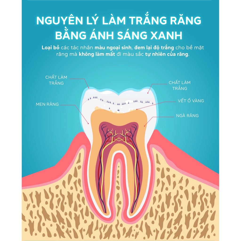 CRESCENT BỘ GEL LÀM TRẮNG RĂNG TẠI NHÀ (BỘ ĐEN)