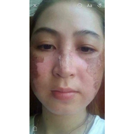 PEEL LỘT THAY DA HOA SEN