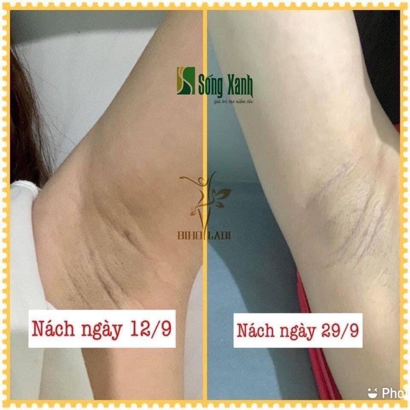 [CHÍNH HÃNG] KEM MỜ THÂM 5S BIHOLADI | BigBuy360 - bigbuy360.vn