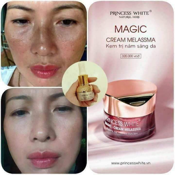 BỘ ĐÔI KẾT HỢP: SERUM 3IN1 & KEM TRỊ NÁM MAGIC “MỜ NÁM TRẮNG DA – CHO NÀNG TRẺ RA” | BigBuy360 - bigbuy360.vn