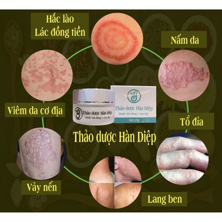Kem bôi Nấm Ngứa, Á Sừng, Vảy Nến, Chàm Sữa, Hăm, Ghẻ - Kem Bôi Da [ CHÍNH HÃNG ]