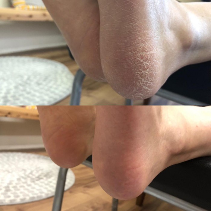 Túi Ủ Bong Da Chết Bàn Chân Mino Baby Foot Nhật Bản - Giảm nứt gót chân, chai chân