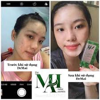 Thảo dược làm sạch mụn, lựa chọn hoàn hảo cho làn da mụn