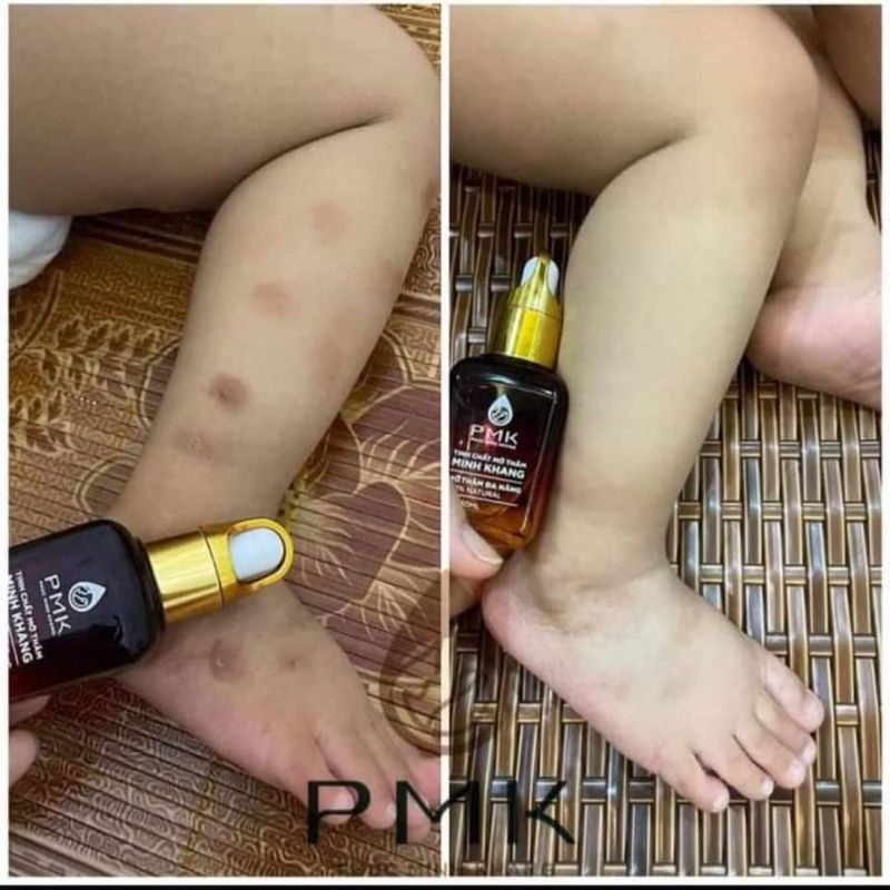 Tinh chất Xóa mờ thâm Minh Khang- Xoá thâm Sẹo,thâm mắt, thâm môi,thâm nách,thâm mụn,thâm gãi ngứa - Chính Hãng