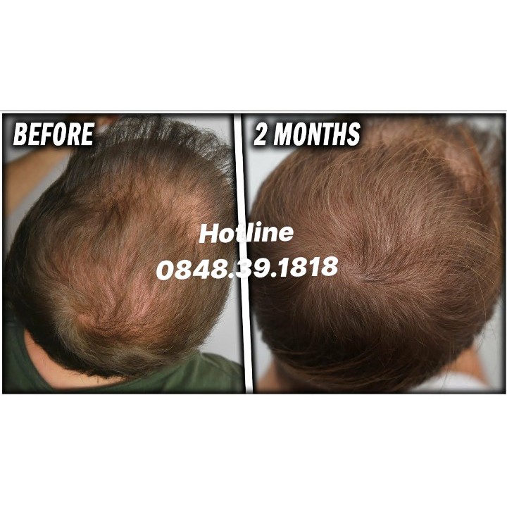 Thuốc mọc tóc Minoxidil & Finasteride 5% - Morr F5