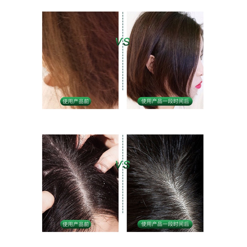 (Bán Buôn – Sỉ) Tẩy Tế Bào Chết Da Đầu NORO Tẩy Tế Bào Chết Da Đầu Kiểm Soát Dầu Nhờn, Giảm Bết Tóc 250g TDCD