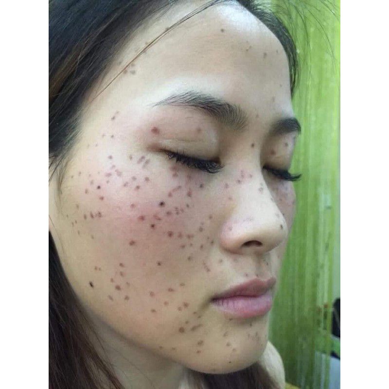 Combo sản phẩm tảo sống chấm nám tàn nhang+kem phục hồi.B3.