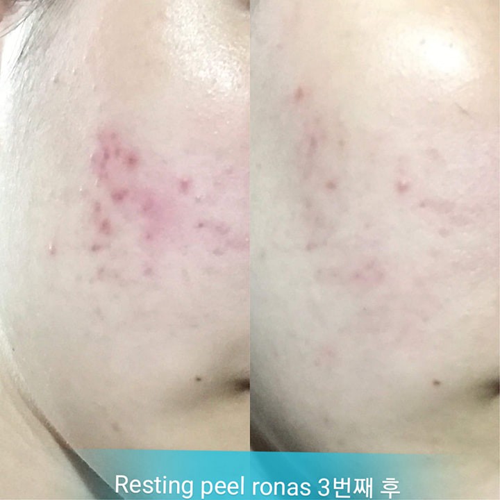 [ Giống như hình] Bộ vi tảo Ronas peel + 1 hộp tế bào gốc Laksmira