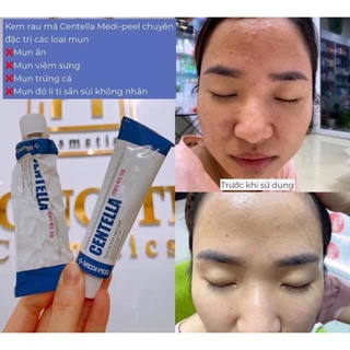 KEM DƯỠNG A313 -RETINOL 0.12%