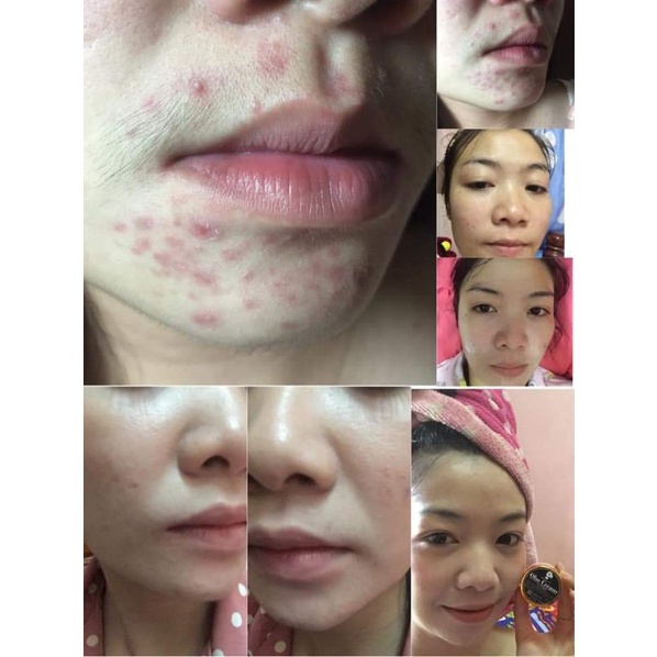 KEM OHO cream ☺ giảm mụn, thâm, sẹo 15g.