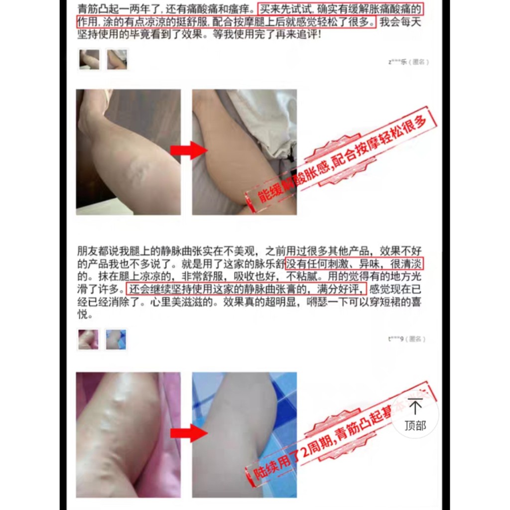 Kem Bôi Suy Giãn Tĩnh Mạch Thấp Khớp Đau Khớp Phong Thấp Maileshu Varicose Veins Treatment Cold Theraby Cream