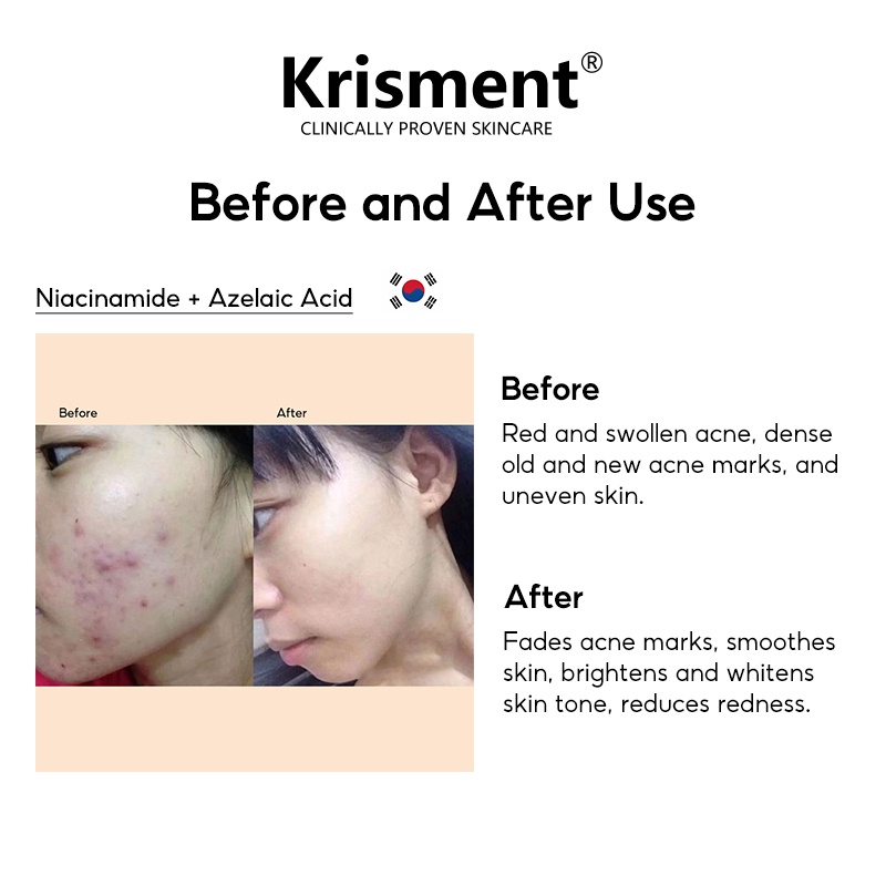 Krisment Serum Azelaic Acid + L-Vitamin C làm mờ vết thâm và vết thâm mụn  30ml