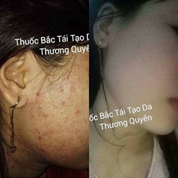 BỘT THUỐC BẮC RỬA MẶT