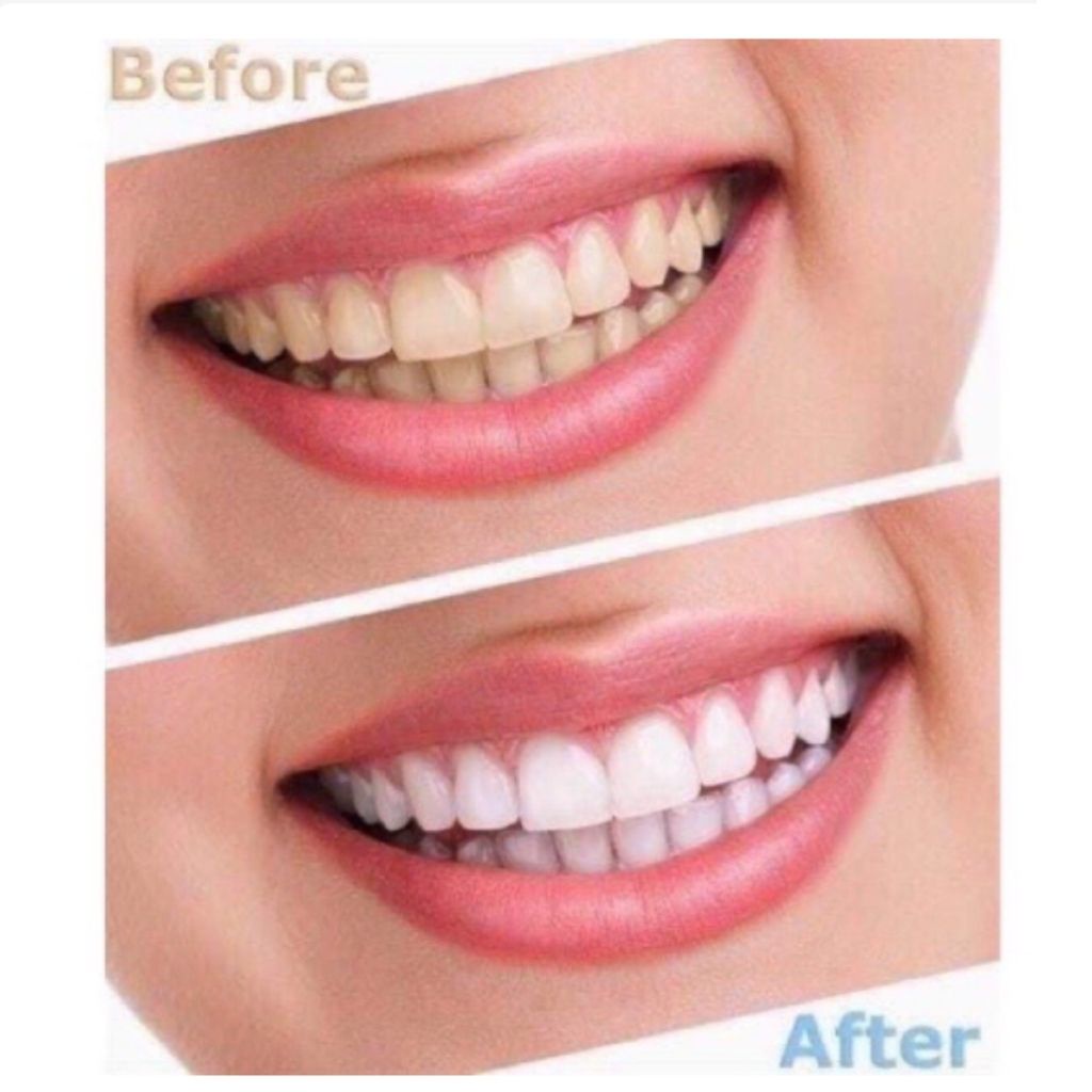 Kem Đánh Răng Hàn Quốc, Đánh Răng Trắng Sáng Median Dental IQ 93% 120g