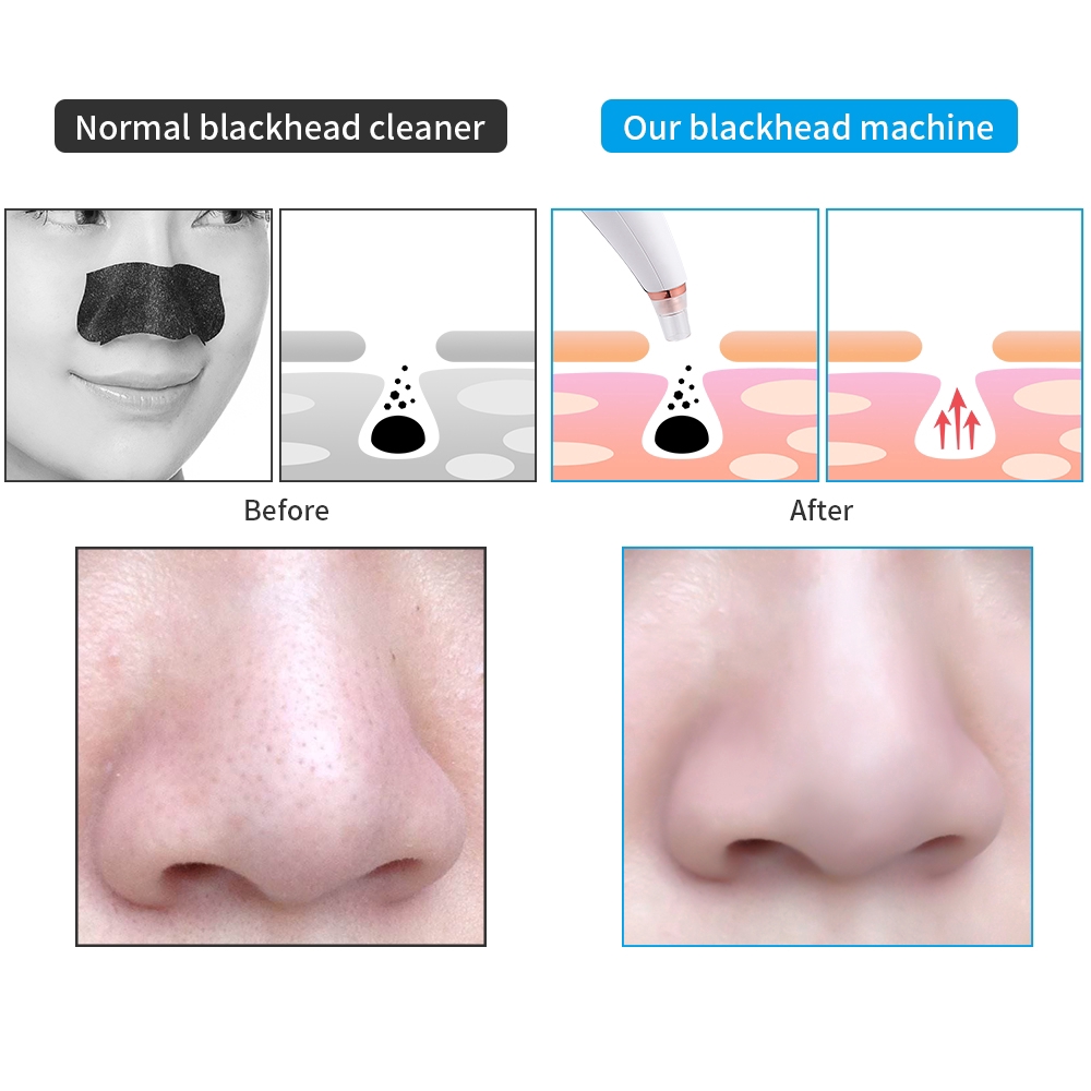 Cổ Phiếu Sẵn Sàng | Máy Hút Mụn Đầu Đen Làm Sạch Sâu Lỗ Chân Lông Chăm Sóc Da Mặt Cổng Usb