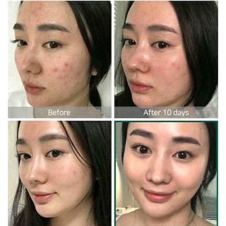 Toner AHA – BHA – PHA 30 Days Miracle