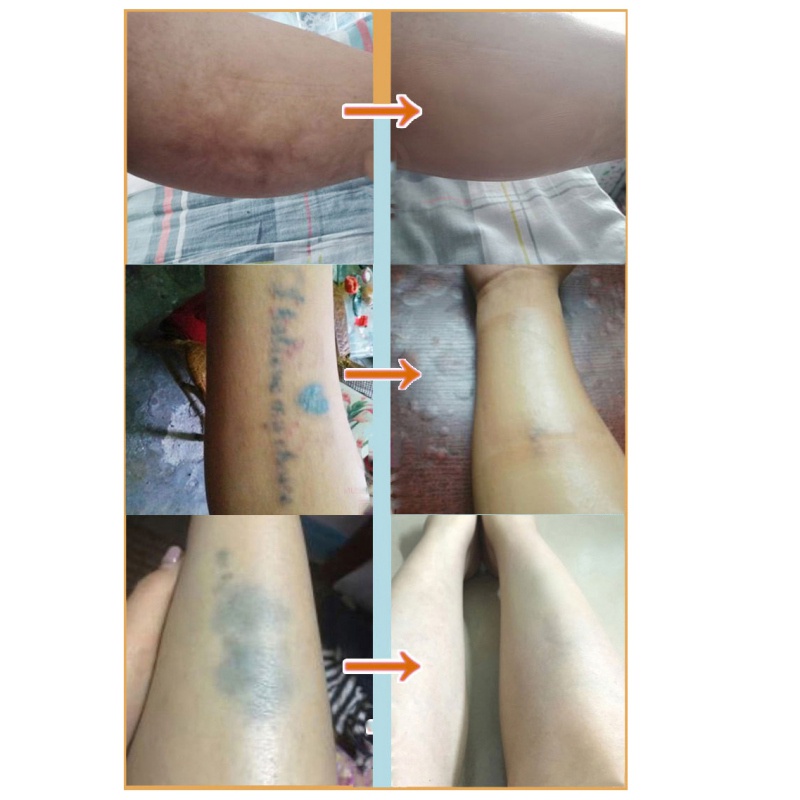 Miếng Dán Che Phủ Sẹo Mụn Thoáng Khí Chống Thấm Nước