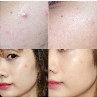 Miếng dán mụn Cosrx Master Patch 24 miếng hút mủ tốt