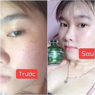 COMBO NÁM HUỲNH ĐỖ( sữa rửa mặt+serum 3w+ kem chuyên nám)